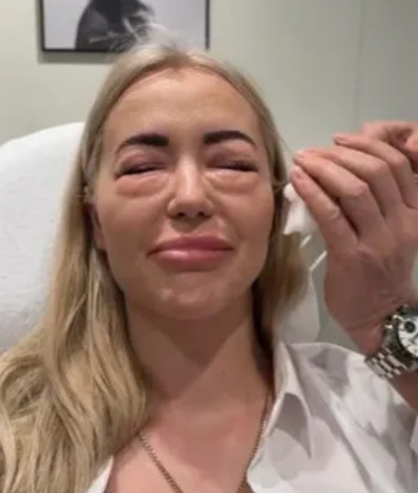 She shocked her followers when she shared images of her swollen eyes online