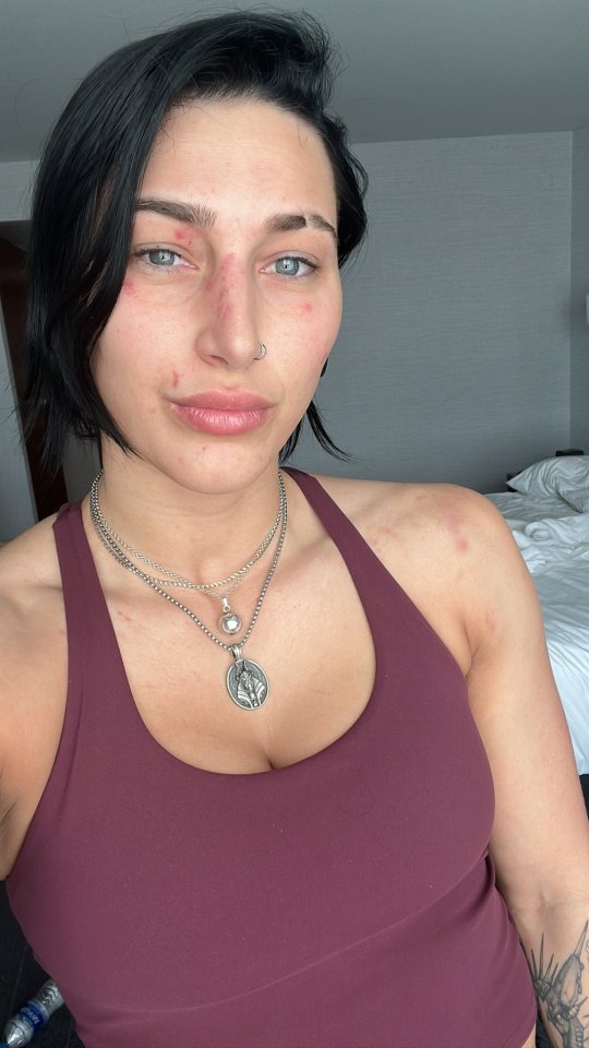 Rhea Ripley shows off her heavily marked face after her brutal Rumble win