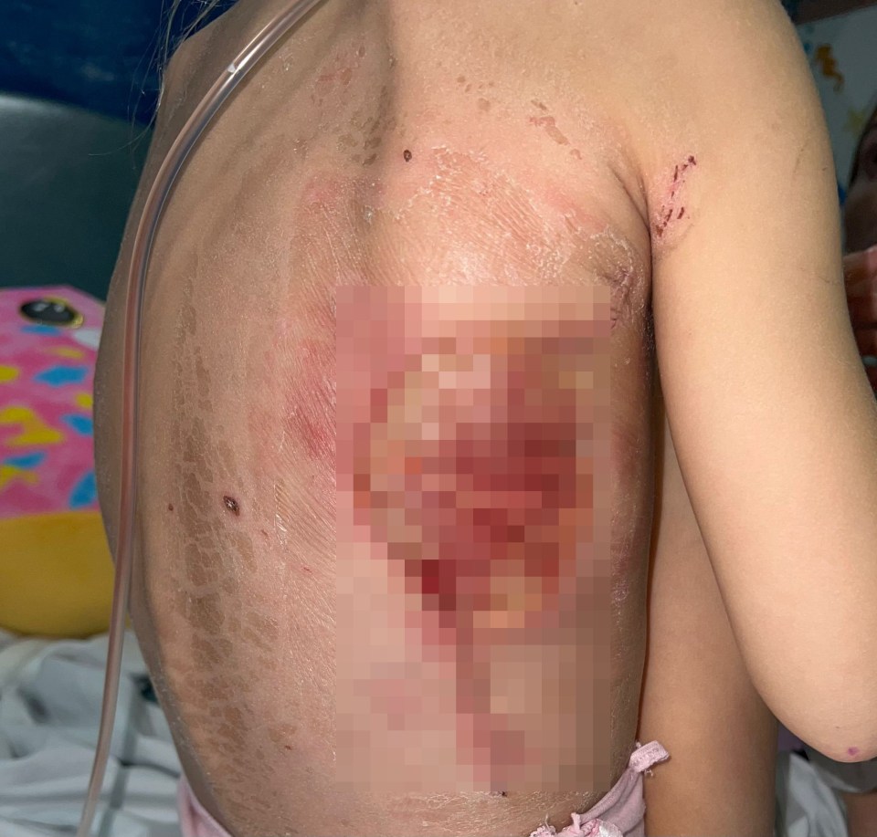 The little girl has been left with a large scar after having to have the bacteria removed