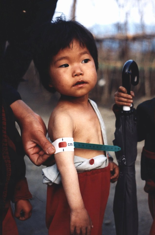 A malnourished girl in April 1997 amid the devastating famine of the 1990s