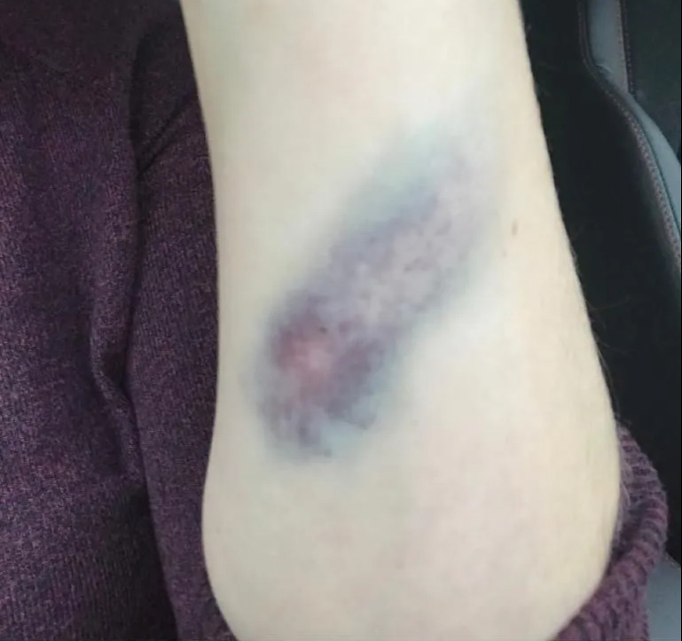 The netball player mistook bruises on her body for harmless bumps caused by netball