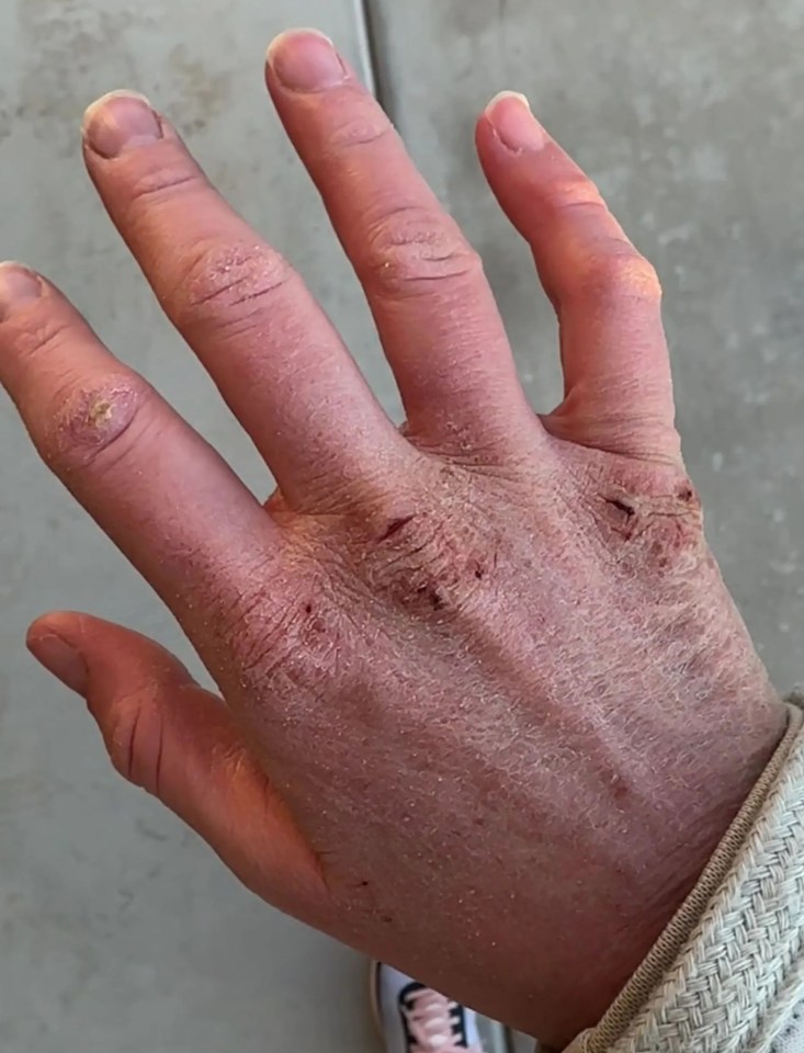 The 36-year-old's hands had become so chapped and cut that she was left struggling to write