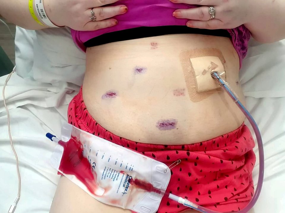 A leak after the operation caused an infection which turned her insides to 'concrete'