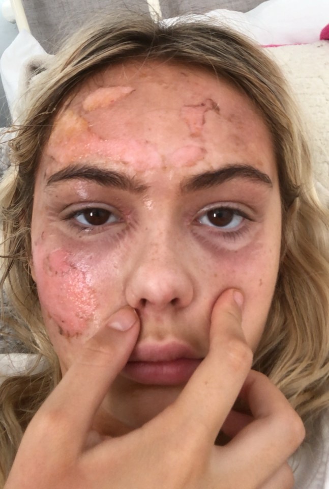 Alice suffered first-degree burns to her face