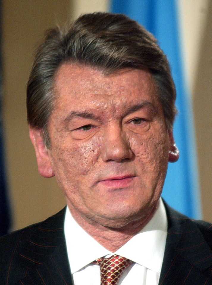 Yushchenko suffered disfigurement after being poisoned