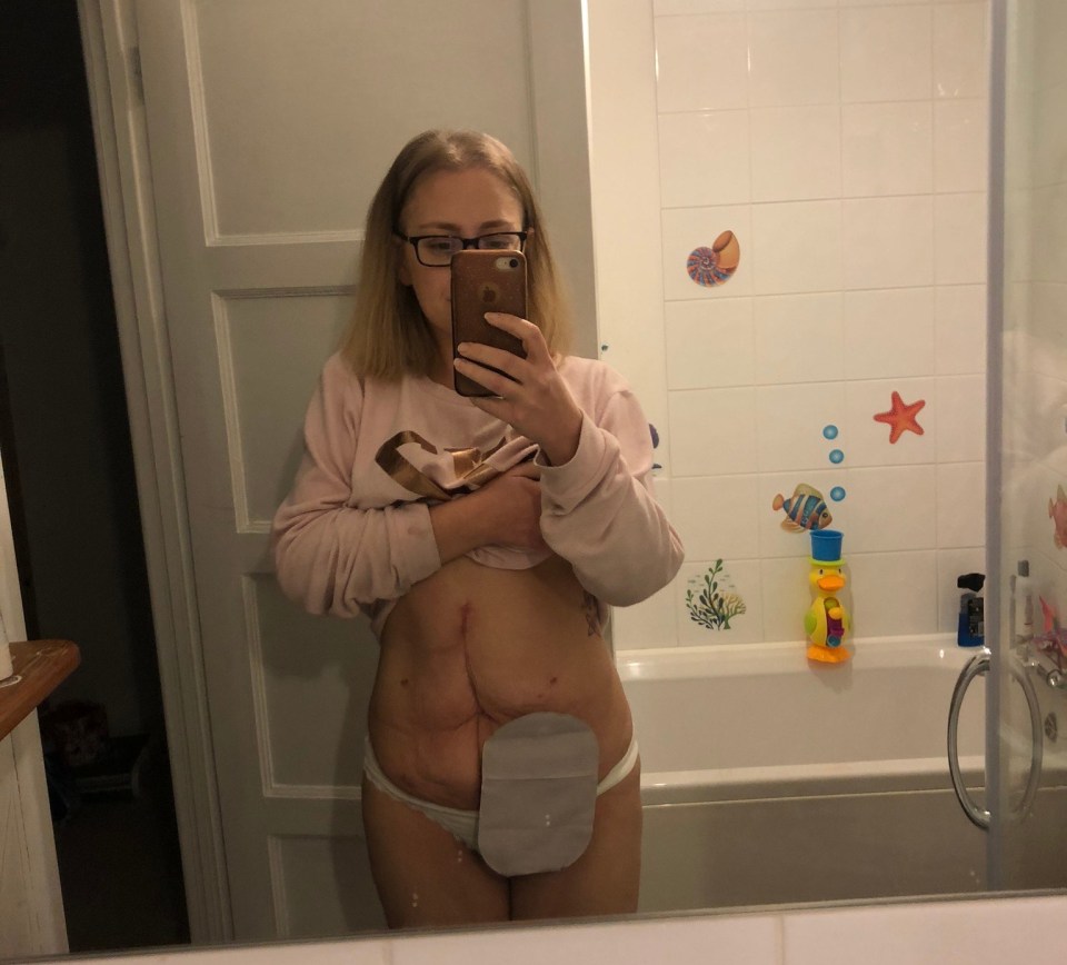 Hannah's scar and stoma after surgery to remove the cancer