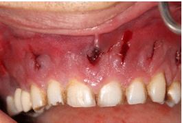 A picture of the man's infected gums