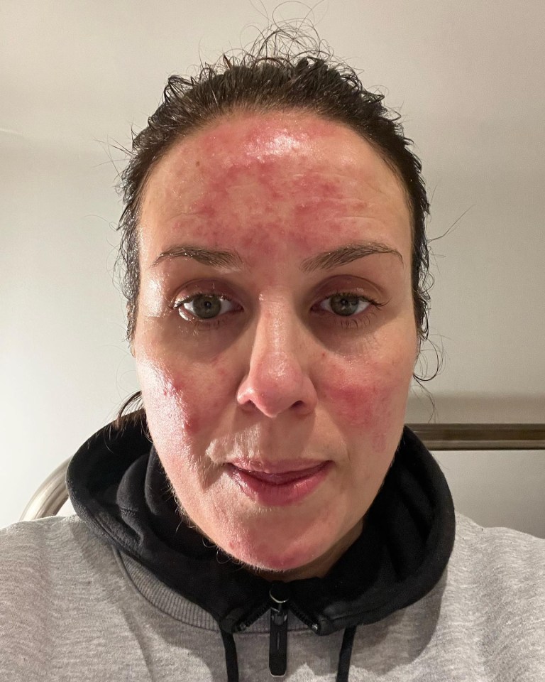 Nina also showed the acne outbreak which has been one of her pregnancy symptoms