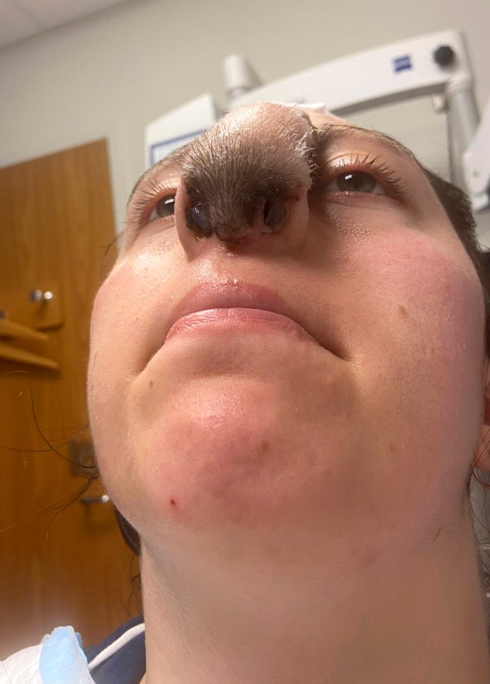 Trinity has hair growing on her nose as doctors used skin grafts from her scalp to recontruct it