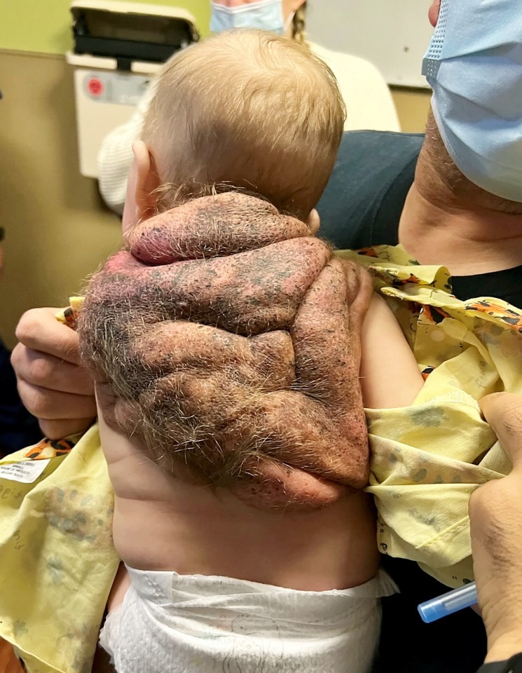 Giant congenital melanocytic nevus is an incredibly rare birth condition that affects around one in every 20,000 newborns