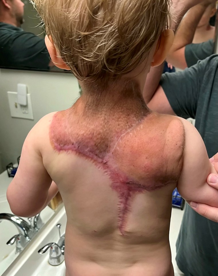 James had two rounds of surgery in February and May 2022 to remove the bulk of his growth