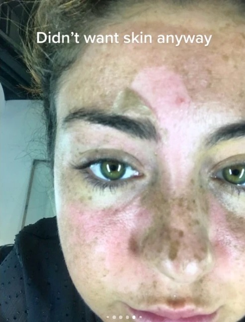 Naomi was left with burns and lost her freckles after going on the sunbed