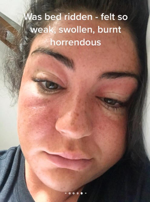 Her skin began to swell before it turned into blisters but trolls say it was her own fault