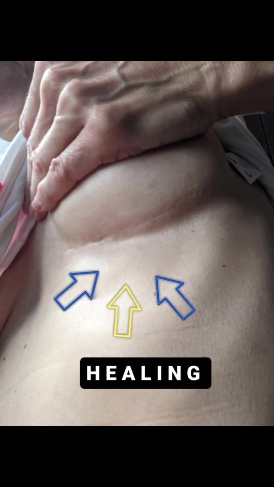 She bravely showed off her healing scars after her mastectomy