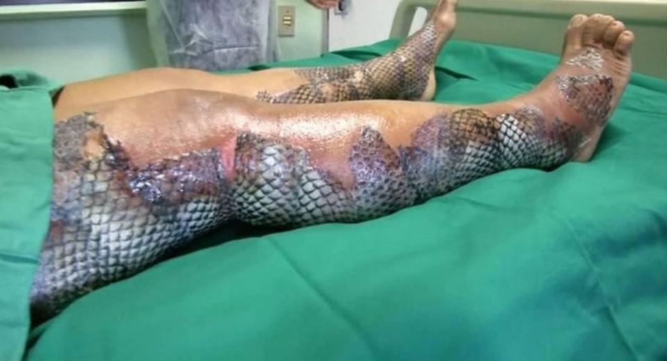 Mind-boggling pictures show burn victim covered in scales