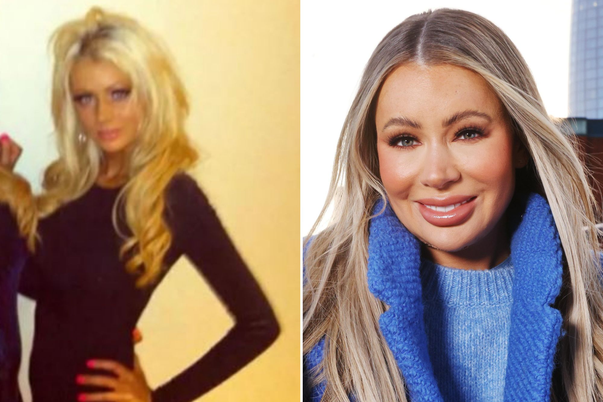 Olivia Attwood has spent thousands on cosmetic surgery and procedures