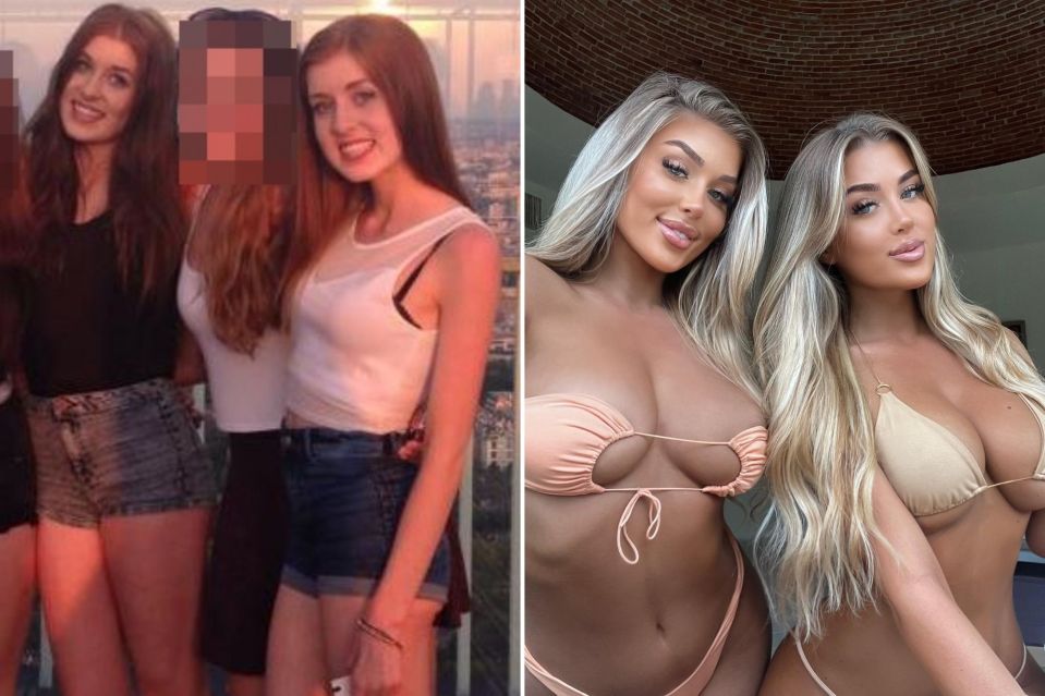 Identical twins Jess and Eve Gale have had matching filler