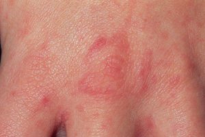  The key symptoms of scabies include intense itching and a nasty raised rash or spots