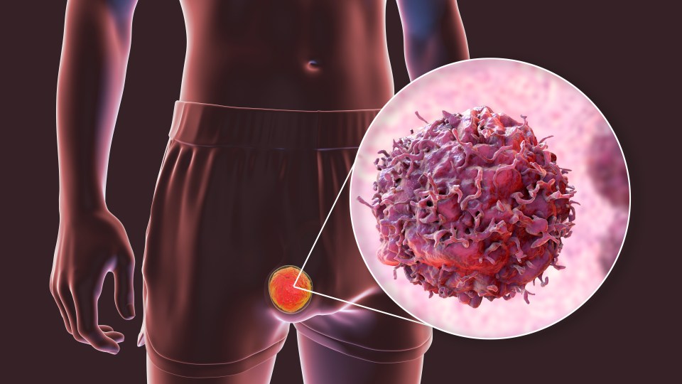 Testicular cancer. Computer illustration showing a malignant tumour in the testis and a close-up view of a testicular cancer cell.