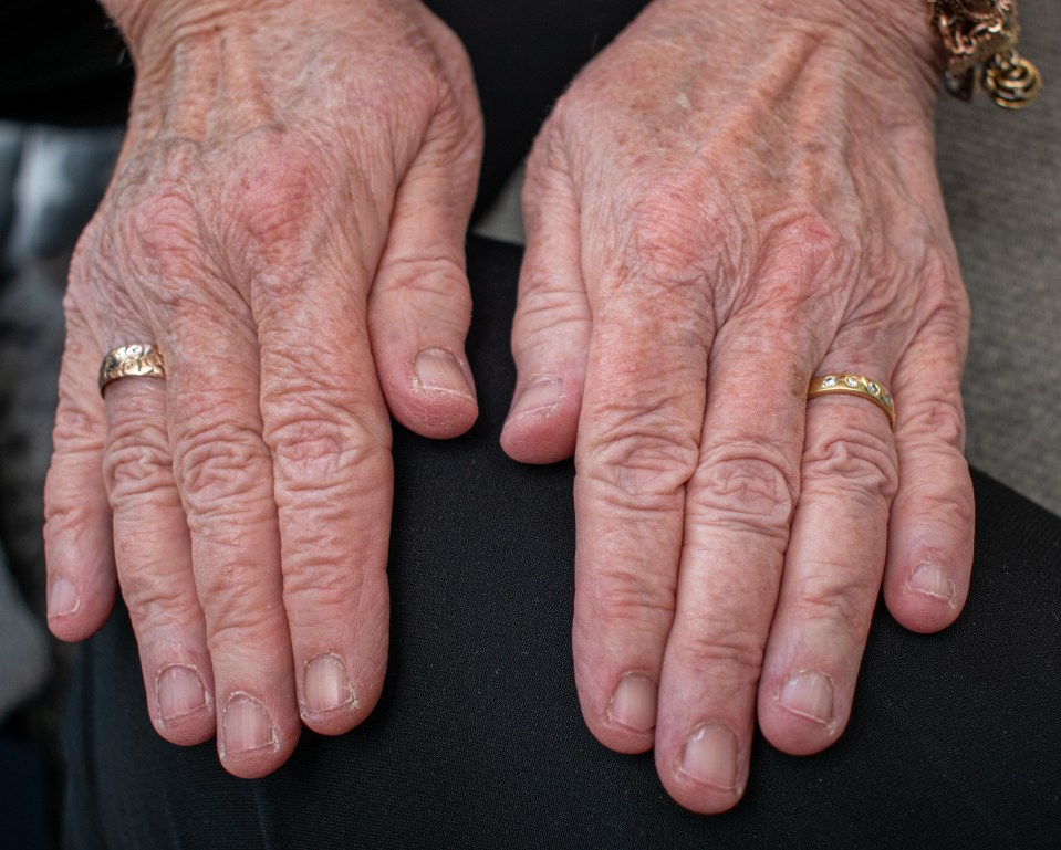 Judith's hands after a night wearing the 'magic' tape