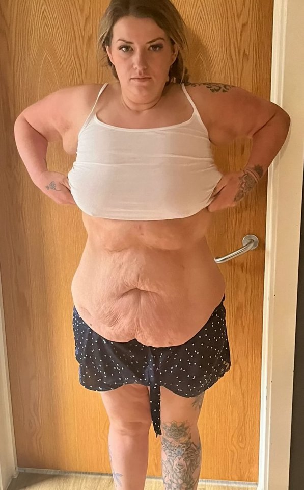 She had excess skin after losing a lot of weight