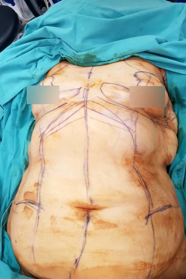 She was marked with surgical pen before the procedure