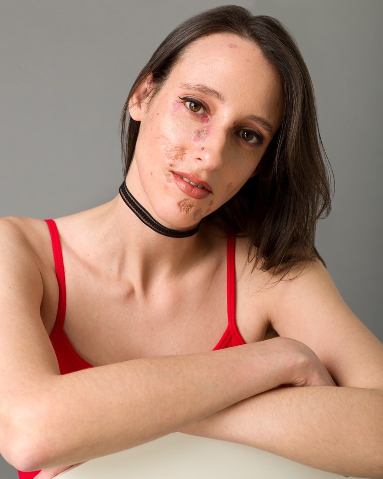 Mikki Leigh, 34, whose face and body was left scarred for life by angry sores, caused by Lupus, has become a diversity model