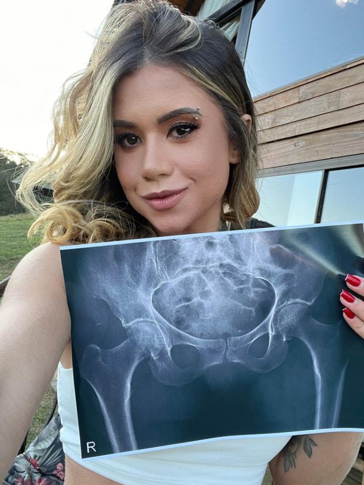 The Brazilian model got an X-ray of her rear end to silence trolls