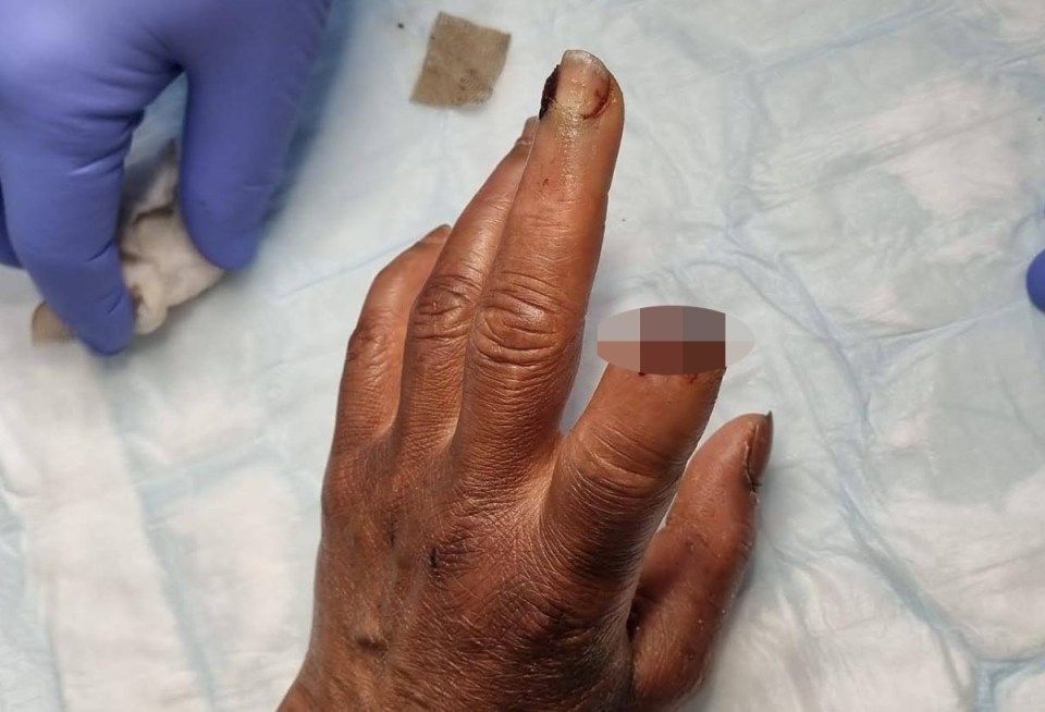 Folake's mum saw her index finger bitten clean off in the attack