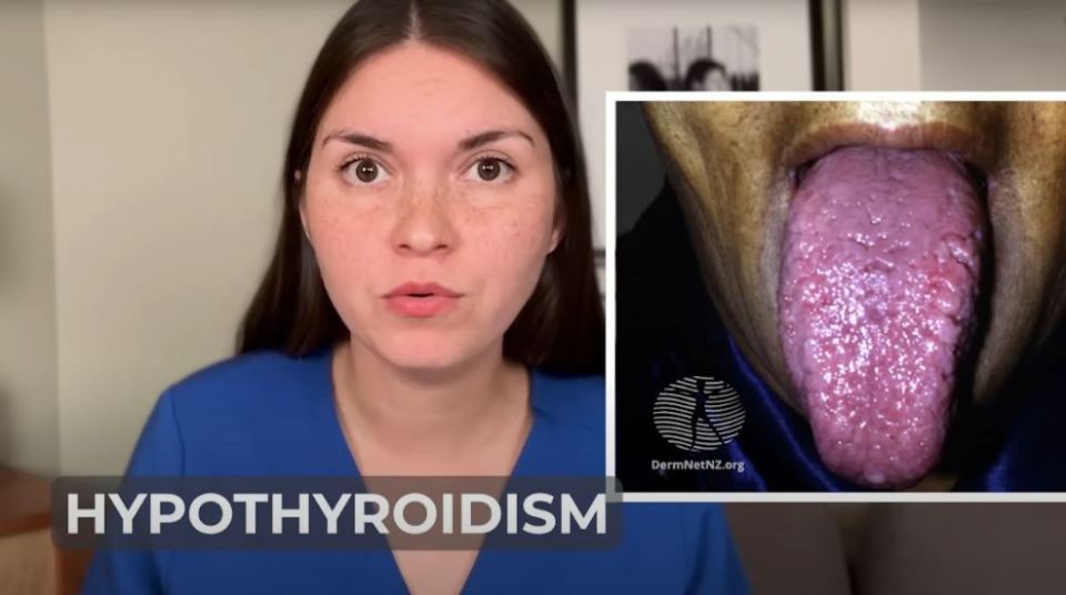 Those with tongues which continue to grow is likely suffering from hypothyroidism