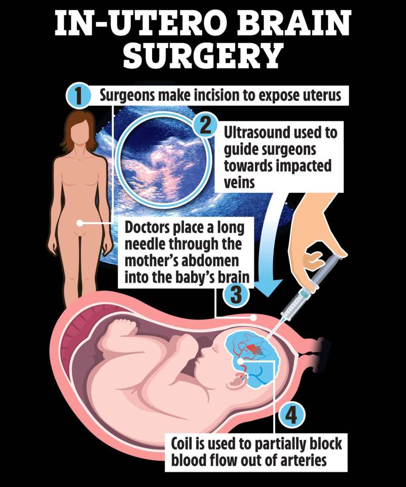 A team of 10 medics used ultrasound to guide a long needle through the mother’s abdomen into the part of the baby’s brain where the arteries were affected.They then injected a small substance into the vessel to block the flow back into the veins