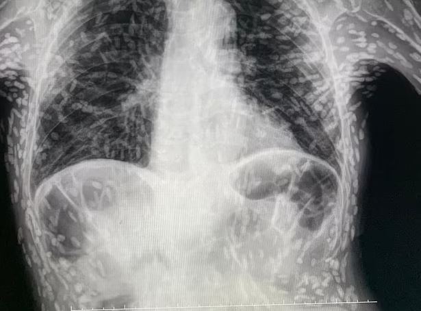 Dr Vitor Borin de Souza a medic at the Hospital das Clínicas in Botucatu shared the shocking image on Twitter, each dot represents a cyst caused by tapeworm larvae