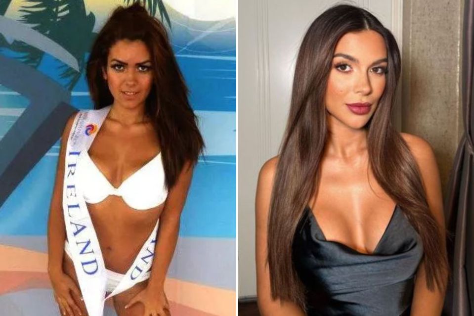 Ekin-Su had 'Turkey teeth' and a massive filler makeover before Love Island last year