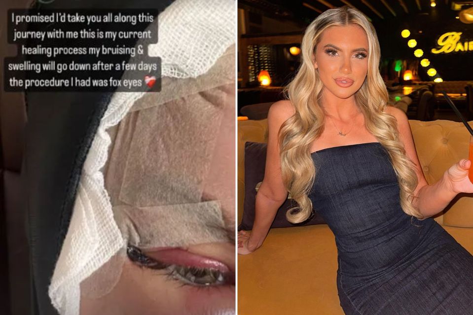 Mollie Salmon is yet to reveal the final results of her 'fox eye' surgery