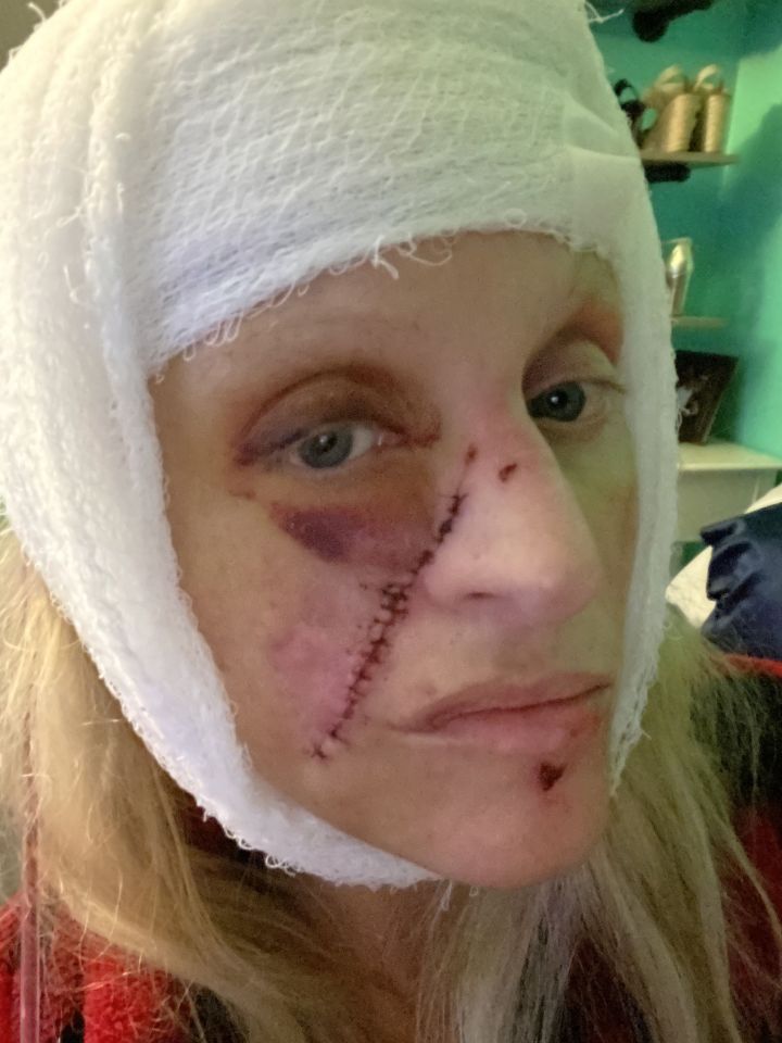 Shelley after surgery in February 2021