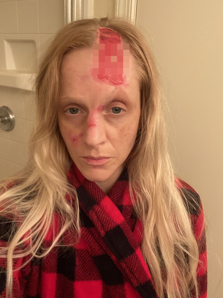 Shelley Puchalsky said half her face 'fell' off after she tripped while out with her dog