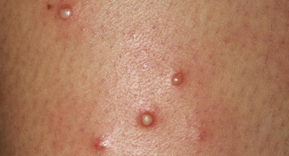 Folliculitis can occur anywhere on the body where hair follicles are present