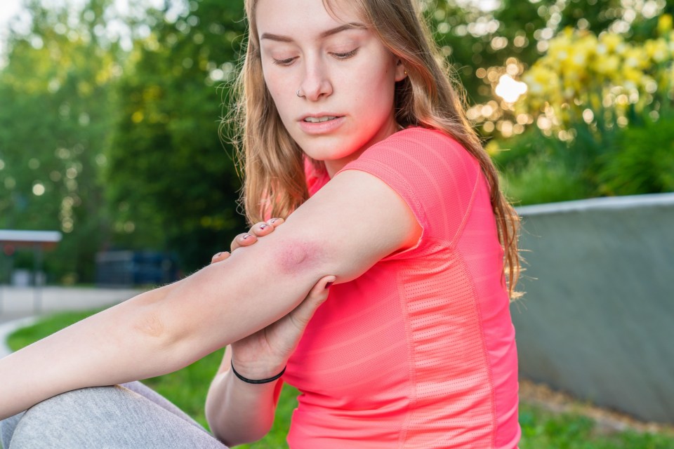 TD916P A young woman examines her insect sting on her arm