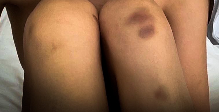 She shared photos of the injuries she sustained from the alleged sexual assault on Twitter