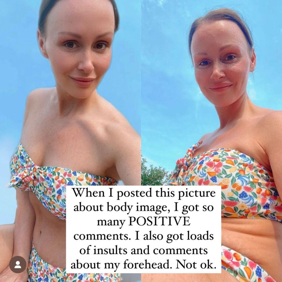 The star recently showed off her 'real' bikini body and received insults about her forehead