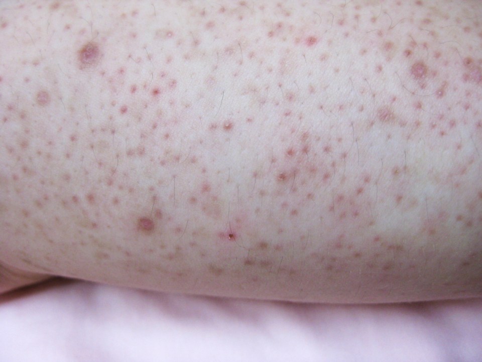 Keratosis pilaris very common skin condition where you get keratin accumulation in the hair follicle