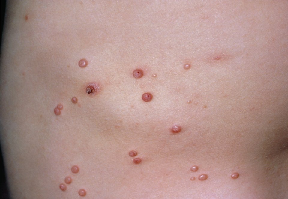 Molluscum contagiosum causes "little bubbles on the skin", experts say