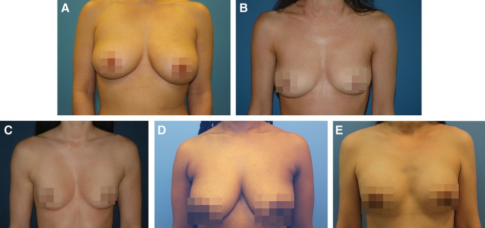 Scientists in New York claim they have found the 'best shape' for someone’s breasts