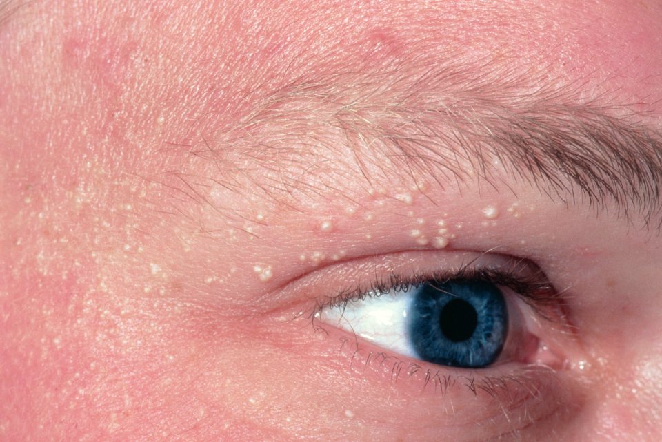 Millia occur around the cheeks, nose, eye and eyelids, so are often confused for acne