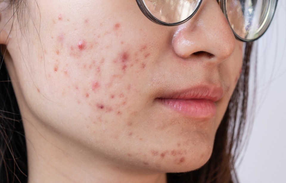 Experts say "there are a few other skin rashes which can look very similar to acne but are not acne"