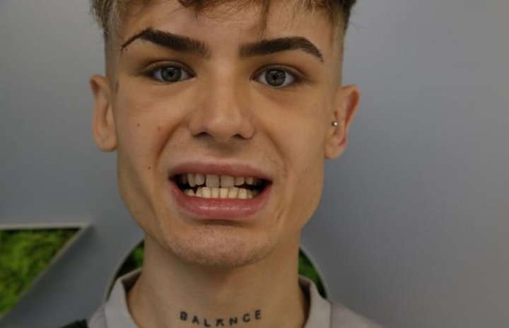 Jack’s teeth before he had the veneers in Turkey