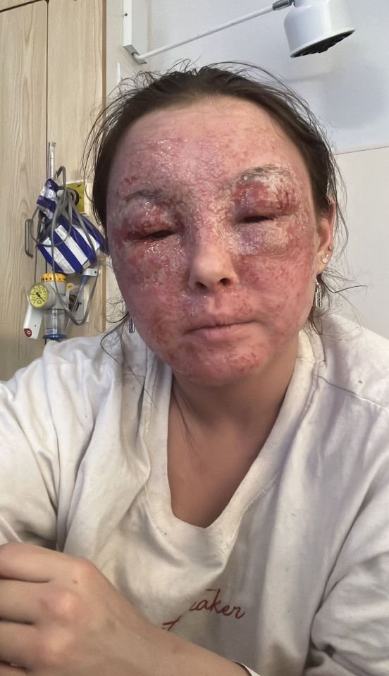 Beatrice Gauca, 22, from Carlow in the Republic of Ireland, suffered an eczema attack that left her feeling like her face was "ripped apart"