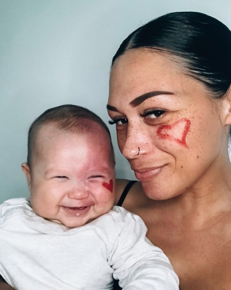 Kingsley, pictured at five-months-old, would have suffered the birthmark thickening and darkening if Brooke didn't start laser sessions