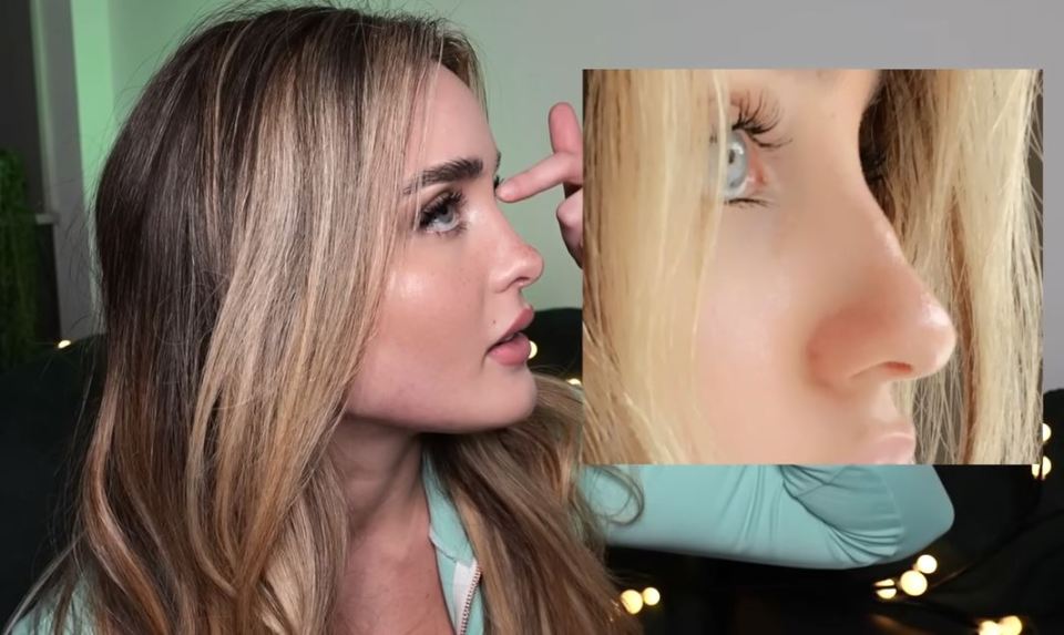 The YouTuber shared that she's had numerous rounds of lip filler and baby botox, as well as a fox eye lift and a rhinoplasty