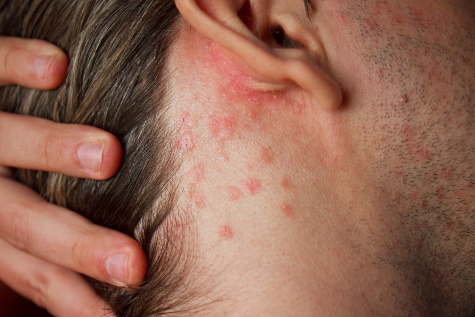 Allergic reactions can occur due to exposure to allergens on the skin